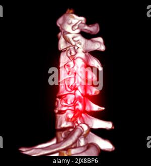 CT SCAN of Cervical Spine ( C-spine ) patient trauma case 3D rendering image . Stock Photo