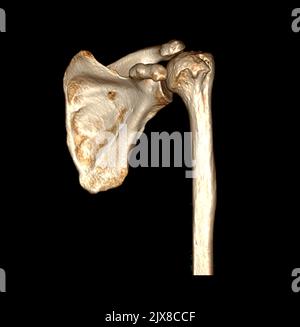 Computed Tomography Volume Rendering examination of the Shoulder 3D rendering in patient fracture shoulder joint. Stock Photo