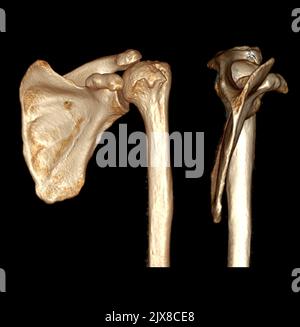 Computed Tomography Volume Rendering examination of the Shoulder 3D rendering in patient fracture shoulder joint. Stock Photo