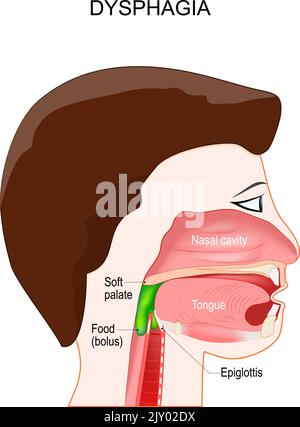 Dysphagia. aspiration food or liquid into the lungs. Swallowing and Process of deglutition. The Epiglottis not closes to prevent aspiration. Vector Stock Vector
