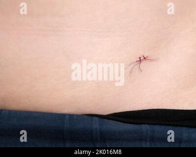 Surgical suture on the body, copy space. Way of connecting tissues of the body Stock Photo