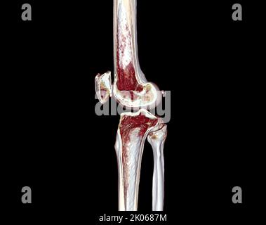 A half of CT Scan of knee 3D rendering image isolated on black ...