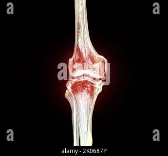A half of CT Scan of knee 3D rendering image isolated on black ...
