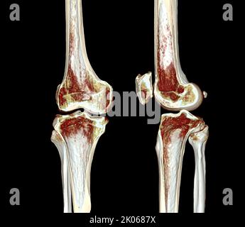 A half of CT Scan of knee 3D rendering image isolated on black ...