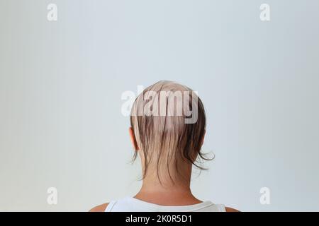 Hair loss in the form of alopecia areata. Bald head of a woman. Hair thinning after covid. Bald patches of total alopecia Stock Photo