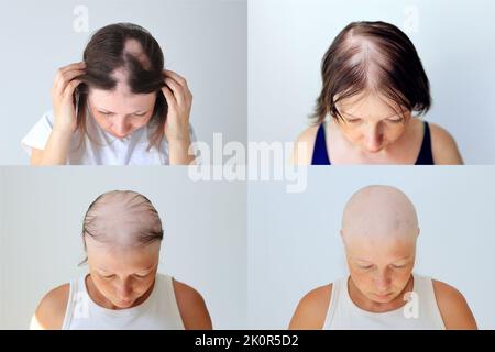 Stages of female head baldness during autoimmune alopecia. Baldness during chemotherapy for cancer Stock Photo