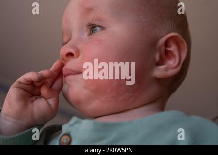 Nettle rash allergy on face in a toddler face. Stock Photo