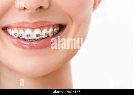 A smiling woman with metal braces on her teeth chews gum Stock Photo ...