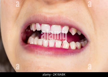 Plaque on human teeth is colored pink with indicator tablets. Stock Photo