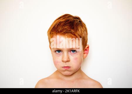 portrait of a boy with allergies. red sick child's eyes. blotchy face Stock Photo