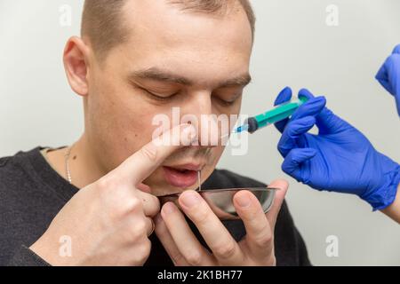 A nurse rinses the nasal cavity of a patient suffering from sinusitis with saline solution using a syringe. Stock Photo