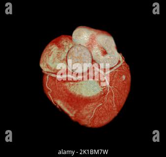 CT Cardiac 3D or CTA coronary artery for prevention coronary artery diseases. Stock Photo