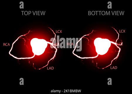 CT Cardiac 3D or CTA coronary artery for prevention coronary artery diseases. Stock Photo