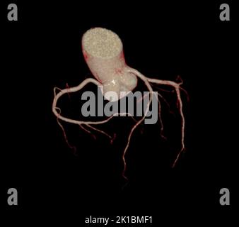 CT Cardiac 3D or CTA coronary artery for prevention coronary artery diseases. Stock Photo