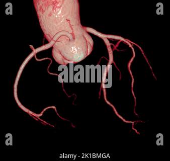 CT Cardiac 3D or CTA coronary artery for prevention coronary artery diseases. Stock Photo