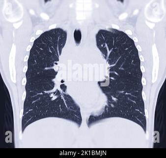 CT Chest Coronal MIP view for diagnostic Pulmonary embolism (PE) , lung cancer and covid-19. . Stock Photo