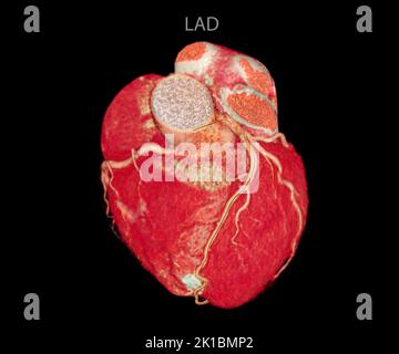 CT Cardiac 3D or CTA coronary artery for prevention coronary artery diseases. Stock Photo