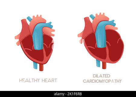Healthy human heart and heart with hypertrophic cardiomyopathy disease ...