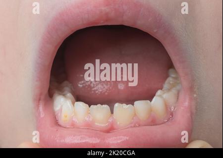 Jaw with child's even teeth close-up, milk and permanent teeth in a child. Stock Photo