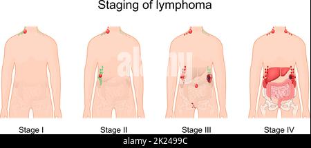 stage of a lymphoma. Cancer of the lymphatic system. Signs and symptoms disease. Human silhouette with normal and enlarged lymph nodes Stock Vector