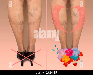 Woman Feet In Pink Shoes Closeup With Small Spider Veins Leg Disease  Unhealthy Side Effect Of Wearing High Heels That Provokes Varicose Veins  Copy Space Top View Stock Photo - Download Image