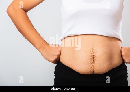 woman showing stretch mark loose lower abdomen skin she fat after pregnancy baby birth Stock Photo