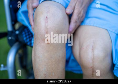 Asian senior or elderly old lady woman patient show her scars surgical total knee joint replacement Suture wound surgery arthroplasty on bed in nursing hospital ward, healthy strong medical concept. Stock Photo