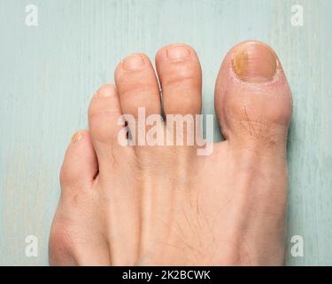 Toenails with fungus problems on green background close up Stock Photo