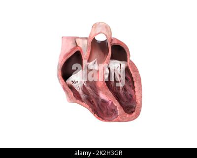 heart anatomy, Left ventricular aneurysm, wall bulge, transmural damage, aneurysm develops, dislocation, aneurysm formation, patient at risk, rupture, thrombus, embolism Stock Photo