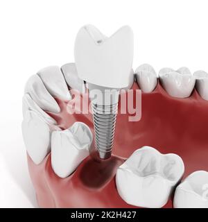 Dental implant detail Stock Photo