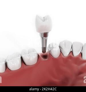 Dental implant detail Stock Photo