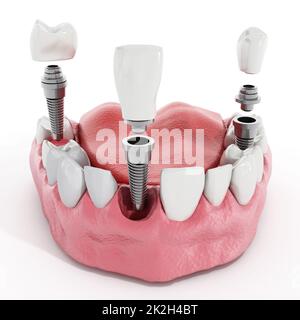 Dental implant detail Stock Photo