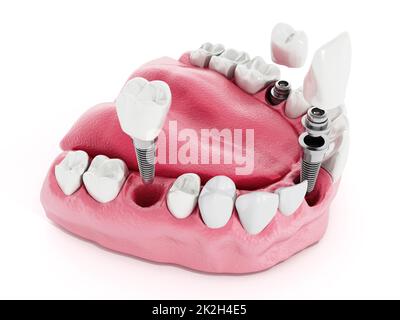 Dental implant detail Stock Photo