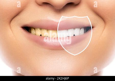 Teeth whitening and hygiene. Result after treatment in professional dental clinic. Stock Photo