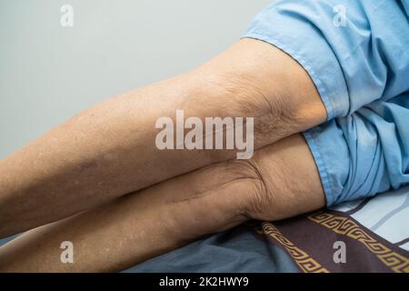 Asian senior or elderly old lady woman patient show her scars surgical total knee joint replacement Suture wound surgery arthroplasty on bed in nursing hospital ward, healthy strong medical concept. Stock Photo