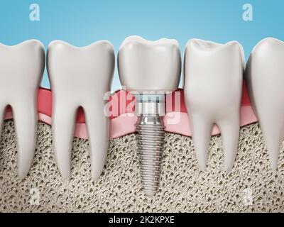 3D rendering of tooth implant showing jaw gum and bone layers. 3D illustration Stock Photo