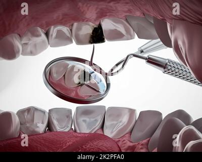Decayed tooth diagnosis and treatment. 3D illustration Stock Photo - Alamy