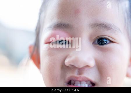 Closed Asian kid little girl eye with sty Stock Photo