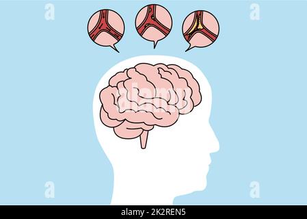 Medical illustration of human brain stroke Stock Photo