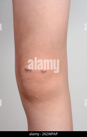 Knee of a girl with keloid scar Stock Photo