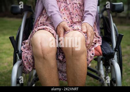 Asian senior or elderly old lady woman patient show her scars surgical total knee joint replacement Suture wound surgery arthroplasty on bed in nursing hospital ward, healthy strong medical concept. Stock Photo