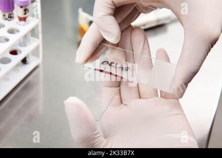 Scientist preparing a bone marrow smear in the laboratory. Blood smear ...