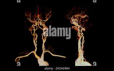 CTA brain or CT angiography of the brain  3D Rendering image for diagnosis cerebral artery aneurysm. Stock Photo