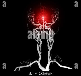 CTA brain or CT angiography of the brain  3D Rendering image for diagnosis cerebral artery aneurysm. Stock Photo