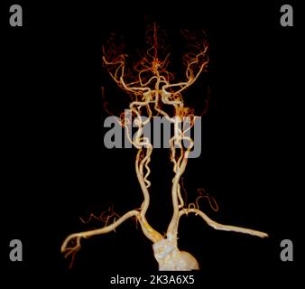 CTA brain or CT angiography of the brain  3D Rendering image for diagnosis cerebral artery aneurysm. Stock Photo