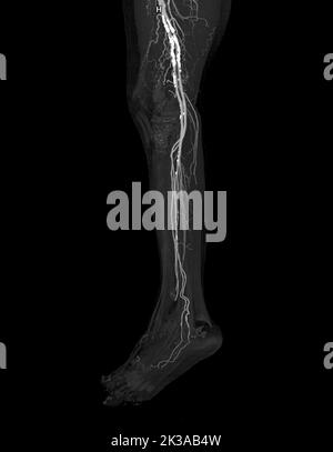 CTA femoral artery run off   image  of femoral artery  Presenting with Acute or Chronic Peripheral Arterial Disease. Stock Photo