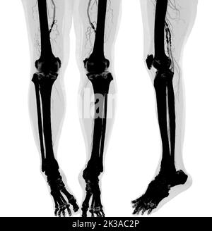 CTA femoral artery run off   image  of femoral artery  Presenting with Acute or Chronic Peripheral Arterial Disease. Stock Photo