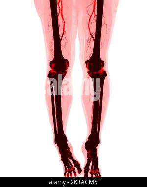 CTA femoral artery run off   image  of femoral artery  Presenting with Acute or Chronic Peripheral Arterial Disease. Stock Photo