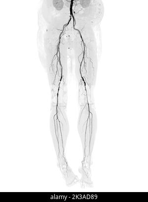 CTA femoral artery run off   image  of femoral artery  Presenting with Acute or Chronic Peripheral Arterial Disease. Stock Photo