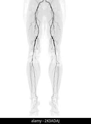 CTA femoral artery run off   image  of femoral artery  Presenting with Acute or Chronic Peripheral Arterial Disease. Stock Photo